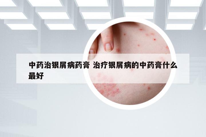 中药治银屑病药膏 治疗银屑病的中药膏什么最好