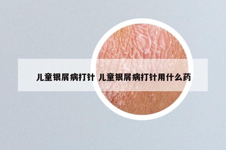 儿童银屑病打针 儿童银屑病打针用什么药