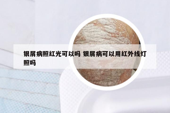 银屑病照红光可以吗 银屑病可以用红外线灯照吗