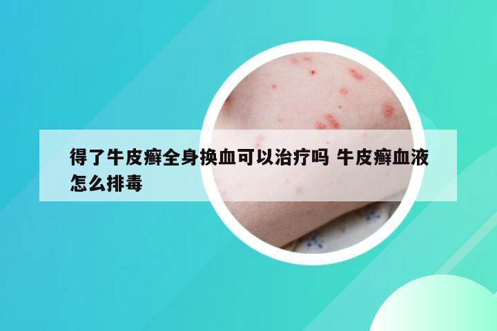 得了牛皮癣全身换血可以治疗吗 牛皮癣血液怎么排毒