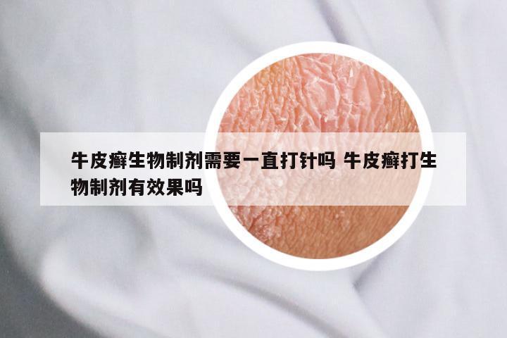 牛皮癣生物制剂需要一直打针吗 牛皮癣打生物制剂有效果吗