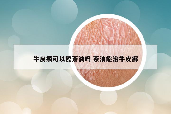 牛皮癣可以擦茶油吗 茶油能治牛皮癣