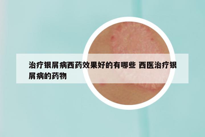 治疗银屑病西药效果好的有哪些 西医治疗银屑病的药物