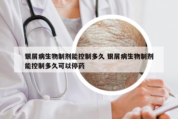 银屑病生物制剂能控制多久 银屑病生物制剂能控制多久可以停药
