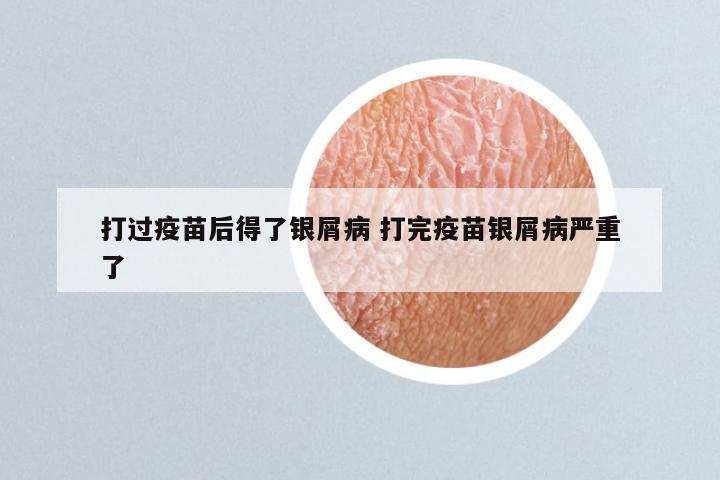 打过疫苗后得了银屑病 打完疫苗银屑病严重了
