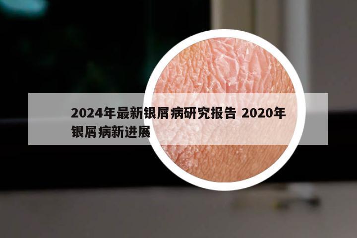 2024年最新银屑病研究报告 2020年银屑病新进展