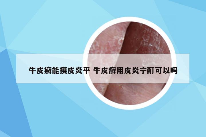 牛皮癣能摸皮炎平 牛皮癣用皮炎宁酊可以吗