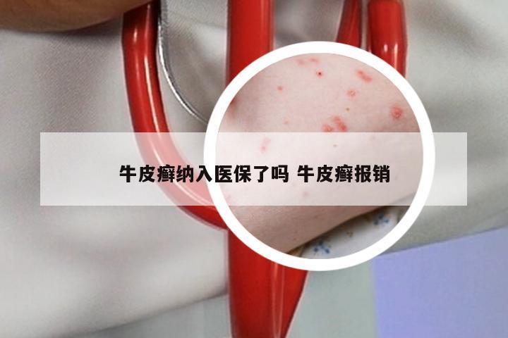 牛皮癣纳入医保了吗 牛皮癣报销