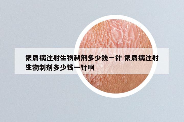 银屑病注射生物制剂多少钱一针 银屑病注射生物制剂多少钱一针啊