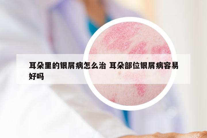 耳朵里的银屑病怎么治 耳朵部位银屑病容易好吗