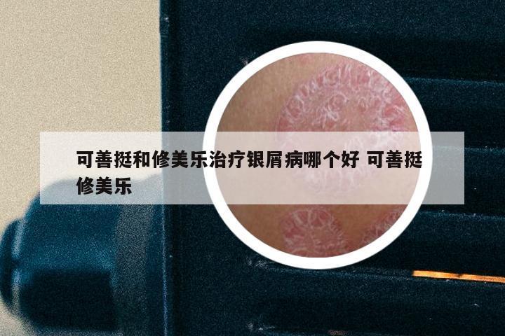 可善挺和修美乐治疗银屑病哪个好 可善挺 修美乐