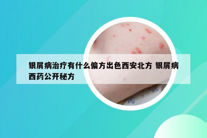 银屑病治疗有什么偏方出色西安北方 银屑病西药公开秘方