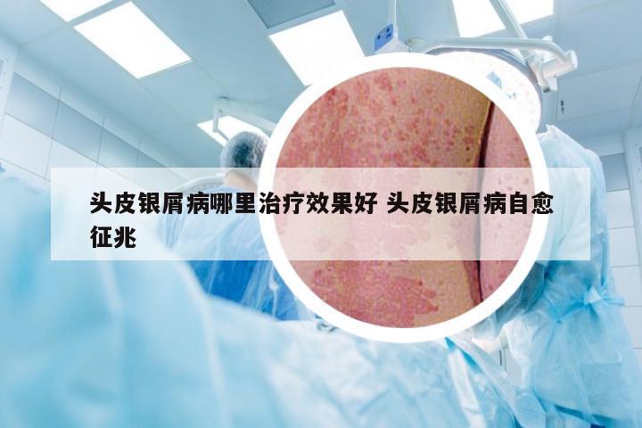 头皮银屑病哪里治疗效果好 头皮银屑病自愈征兆