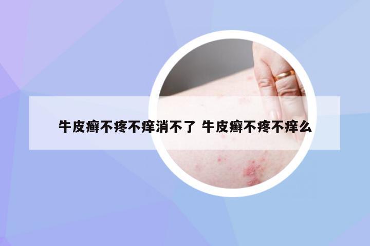 牛皮癣不疼不痒消不了 牛皮癣不疼不痒么