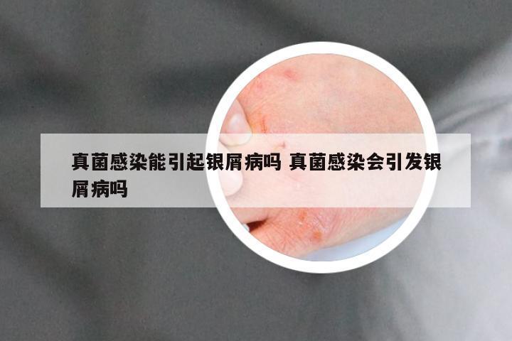 真菌感染能引起银屑病吗 真菌感染会引发银屑病吗