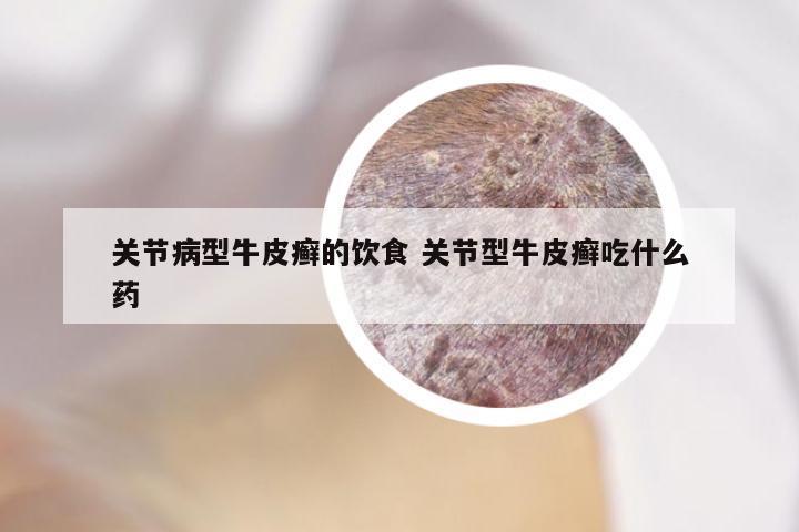 关节病型牛皮癣的饮食 关节型牛皮癣吃什么药