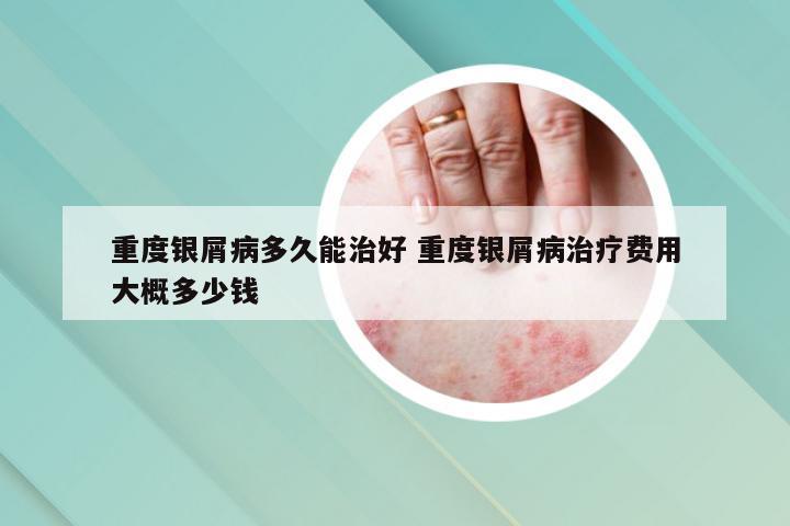 重度银屑病多久能治好 重度银屑病治疗费用大概多少钱
