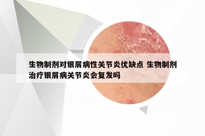 生物制剂对银屑病性关节炎优缺点 生物制剂治疗银屑病关节炎会复发吗