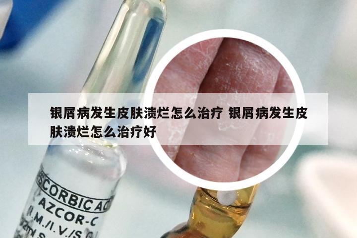 银屑病发生皮肤溃烂怎么治疗 银屑病发生皮肤溃烂怎么治疗好