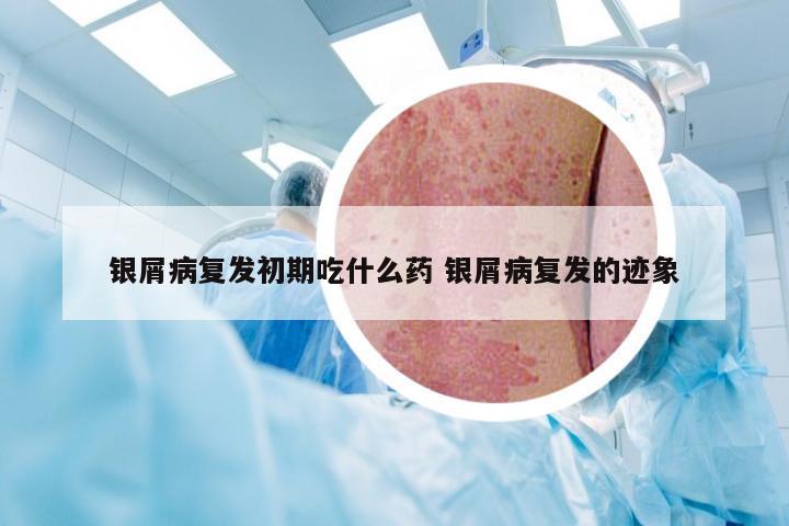 银屑病复发初期吃什么药 银屑病复发的迹象