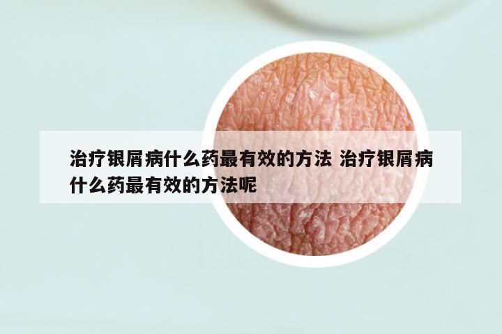 治疗银屑病什么药最有效的方法 治疗银屑病什么药最有效的方法呢