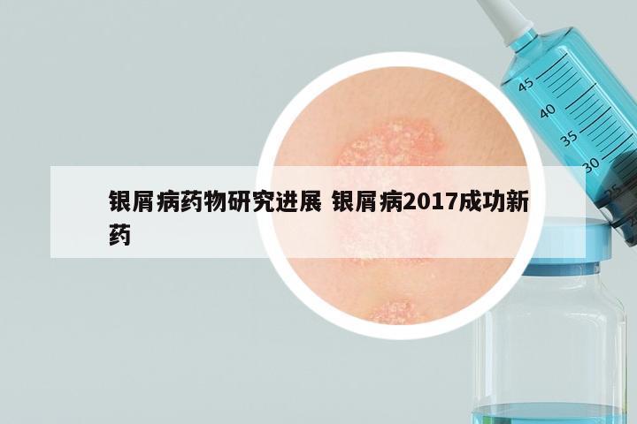 银屑病药物研究进展 银屑病2017成功新药
