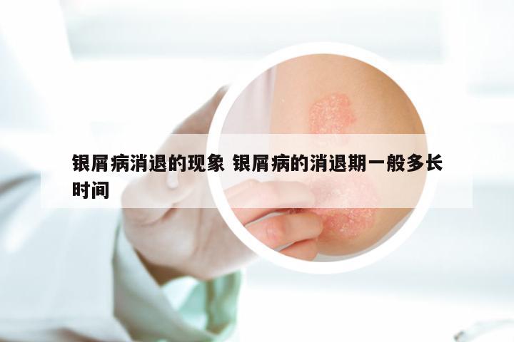 银屑病消退的现象 银屑病的消退期一般多长时间