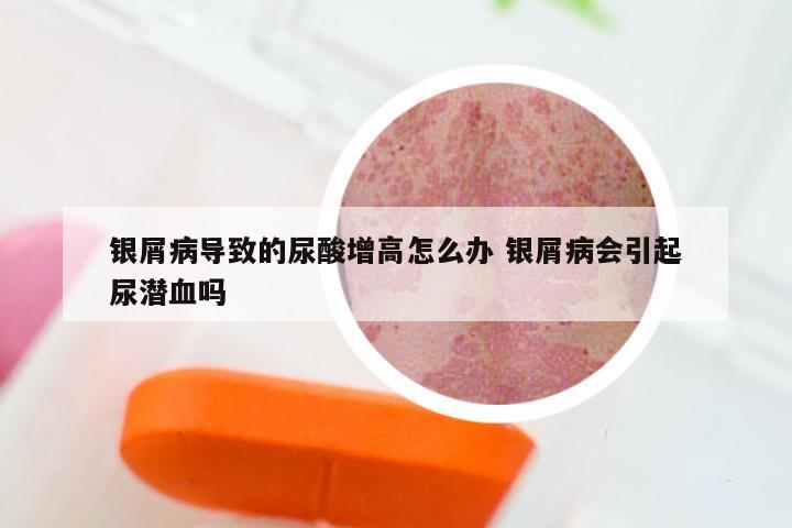 银屑病导致的尿酸增高怎么办 银屑病会引起尿潜血吗