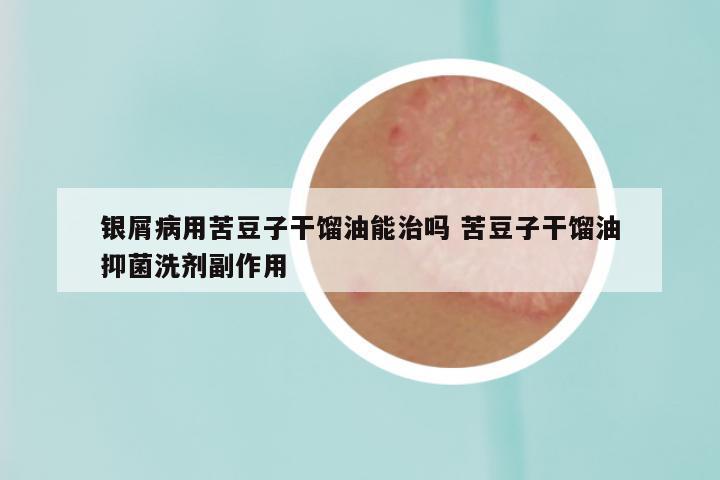 银屑病用苦豆子干馏油能治吗 苦豆子干馏油抑菌洗剂副作用