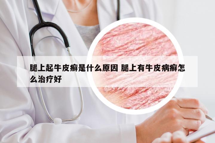 腿上起牛皮癣是什么原因 腿上有牛皮病癣怎么治疗好