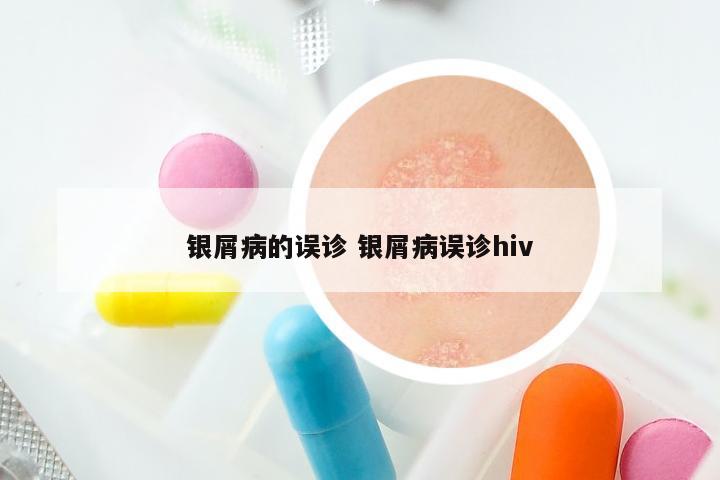 银屑病的误诊 银屑病误诊hiv