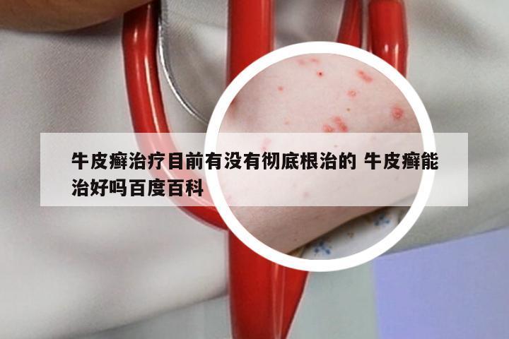 牛皮癣治疗目前有没有彻底根治的 牛皮癣能治好吗百度百科