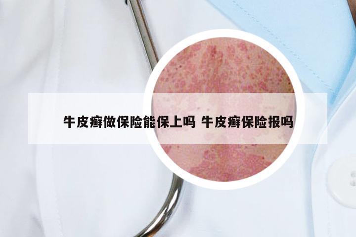 牛皮癣做保险能保上吗 牛皮癣保险报吗
