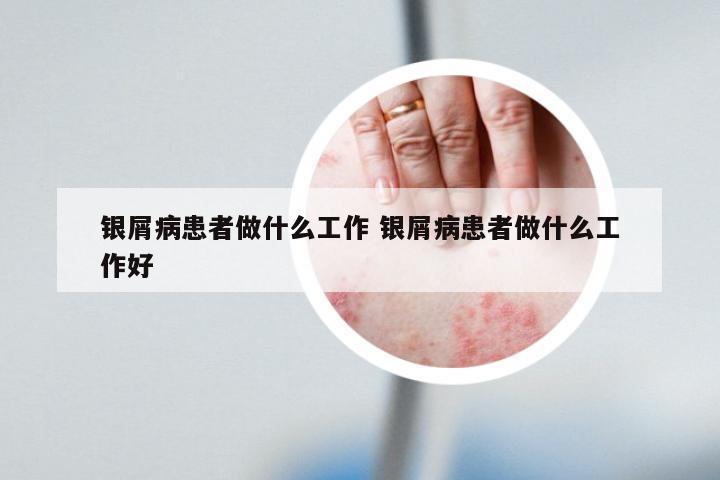 银屑病患者做什么工作 银屑病患者做什么工作好