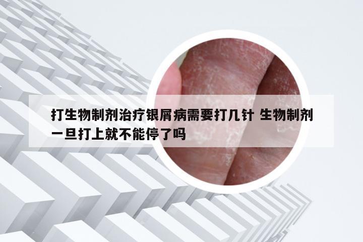 打生物制剂治疗银屑病需要打几针 生物制剂一旦打上就不能停了吗