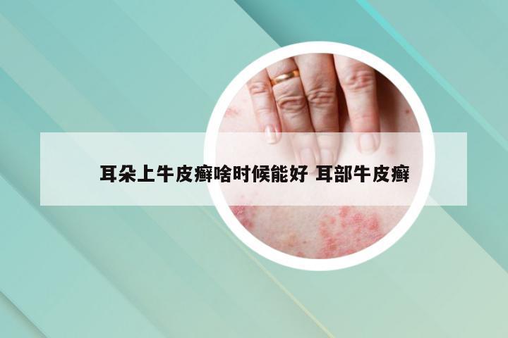 耳朵上牛皮癣啥时候能好 耳部牛皮癣