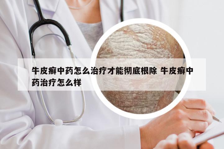 牛皮癣中药怎么治疗才能彻底根除 牛皮癣中药治疗怎么样