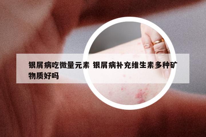 银屑病吃微量元素 银屑病补充维生素多种矿物质好吗