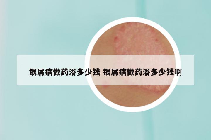 银屑病做药浴多少钱 银屑病做药浴多少钱啊