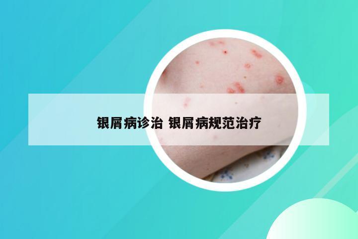 银屑病诊治 银屑病规范治疗