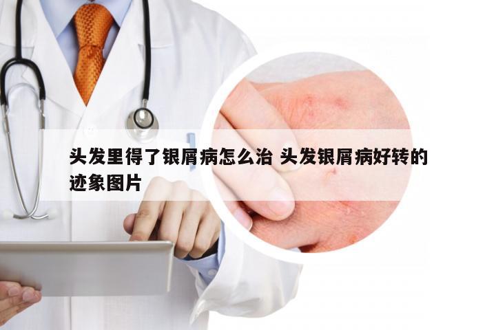 头发里得了银屑病怎么治 头发银屑病好转的迹象图片