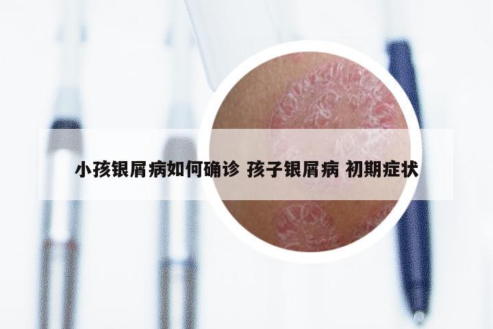 小孩银屑病如何确诊 孩子银屑病 初期症状