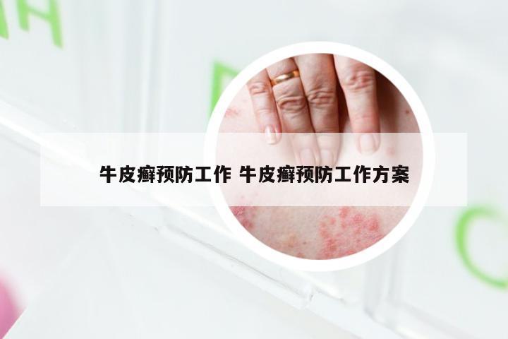 牛皮癣预防工作 牛皮癣预防工作方案