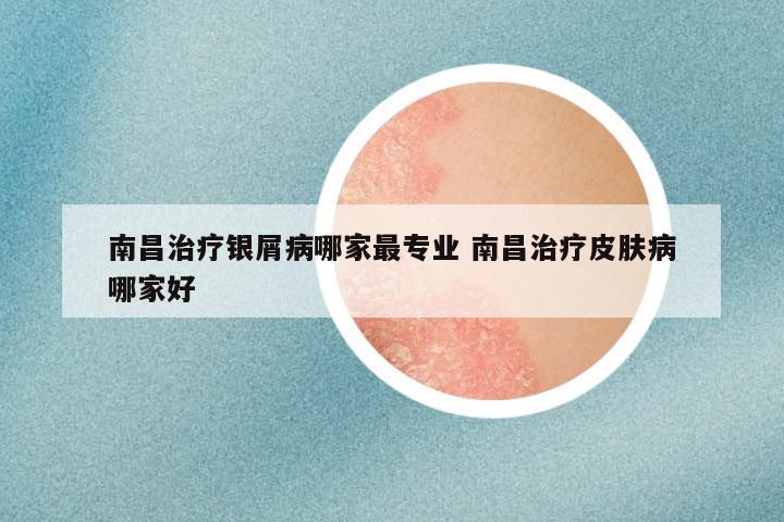 南昌治疗银屑病哪家最专业 南昌治疗皮肤病哪家好