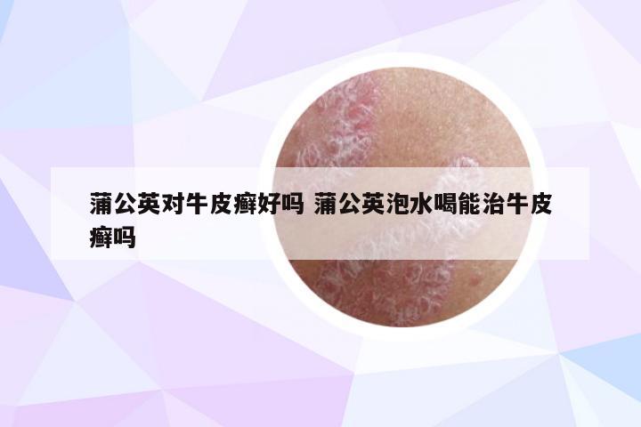 蒲公英对牛皮癣好吗 蒲公英泡水喝能治牛皮癣吗
