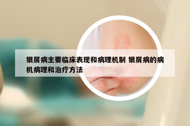 银屑病主要临床表现和病理机制 银屑病的病机病理和治疗方法