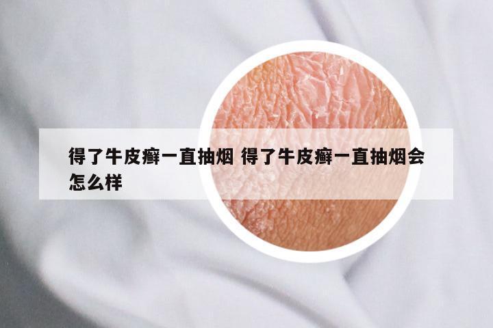 得了牛皮癣一直抽烟 得了牛皮癣一直抽烟会怎么样