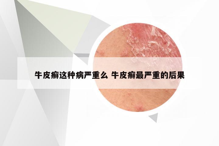 牛皮癣这种病严重么 牛皮癣最严重的后果