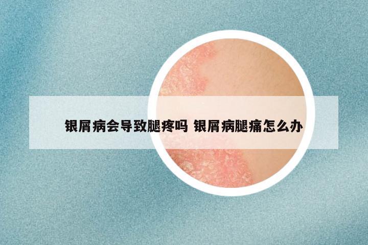 银屑病会导致腿疼吗 银屑病腿痛怎么办