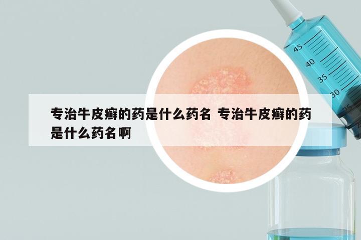 专治牛皮癣的药是什么药名 专治牛皮癣的药是什么药名啊